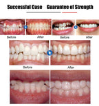 Invisible Braces Orthodontic Braces | Other