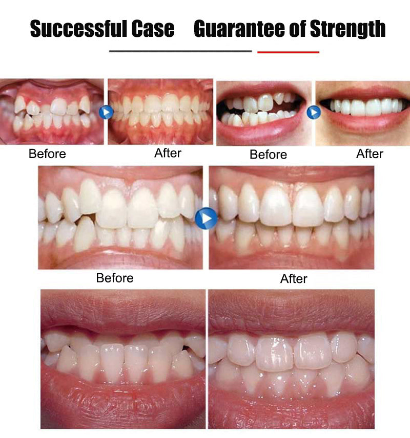 Invisible Braces Orthodontic Braces | Other
