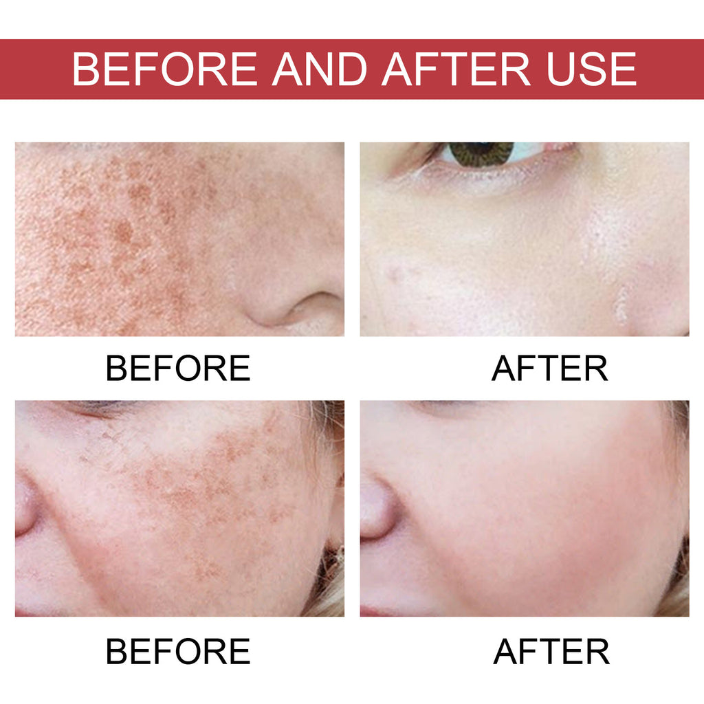 Hoygi Black Spot Repair Essence Lighten Skin Black